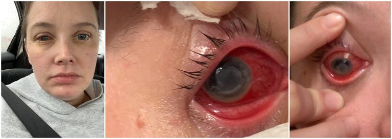 masa infection after lasik